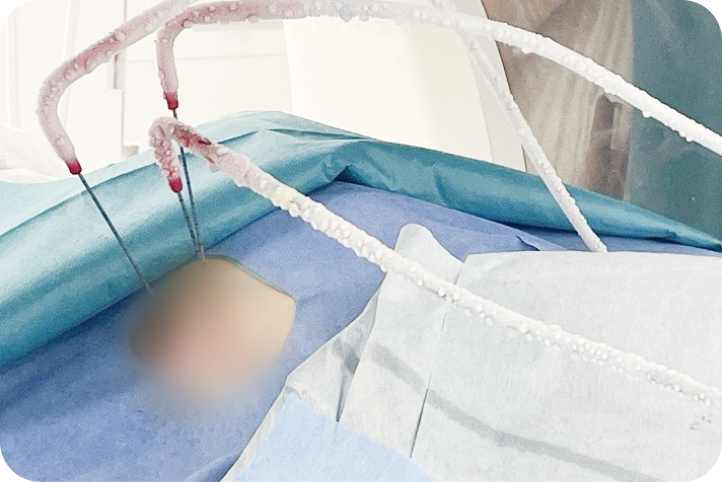 手術用シートに囲まれた患部へ、冷却されたチューブ状の器具が伸びる医療処置中の場面